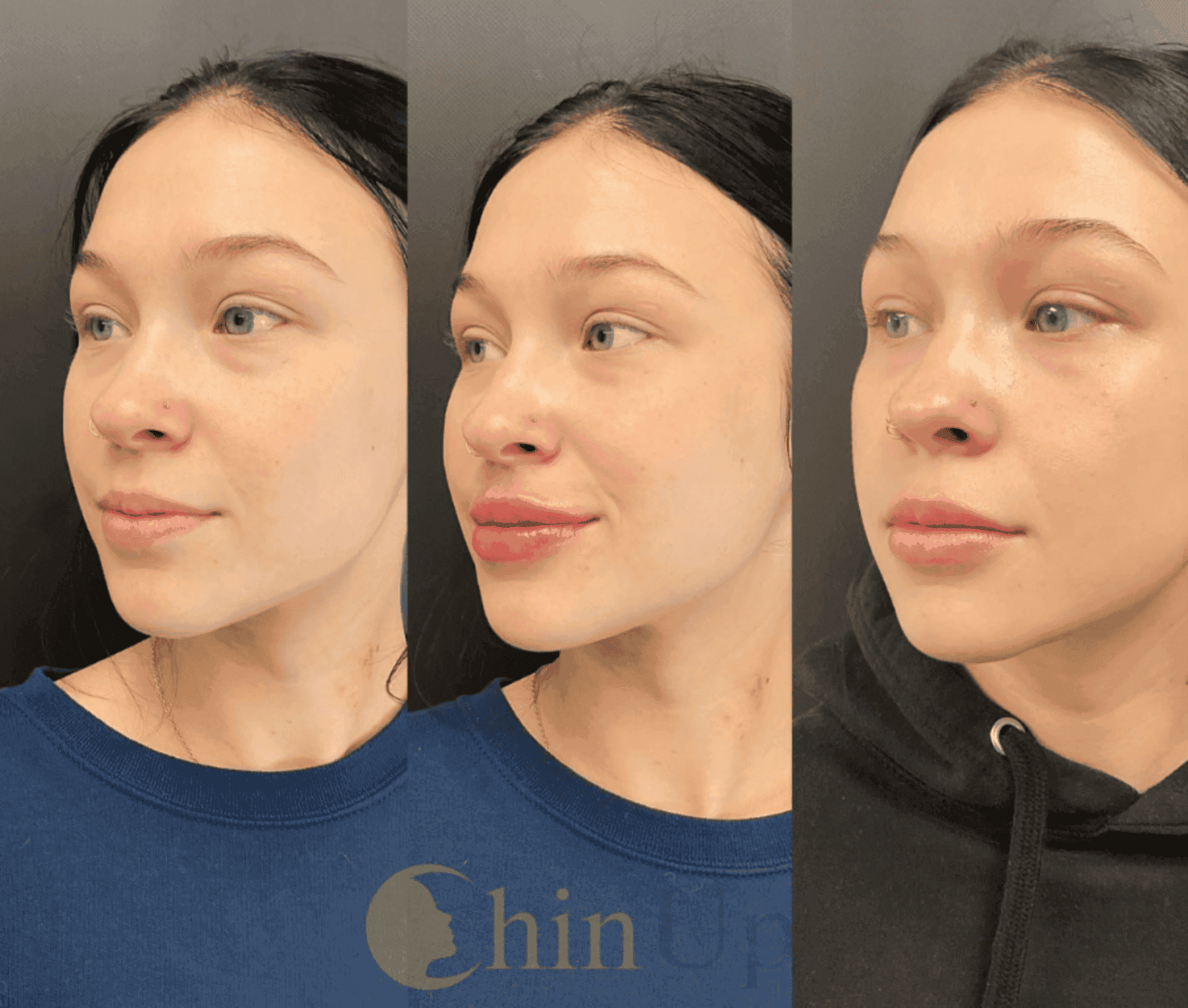 Chin augmentation before and after, side profile comparison